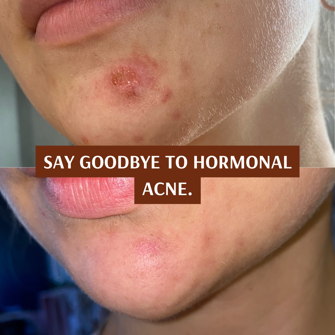 Hormonal Clear Concentrate