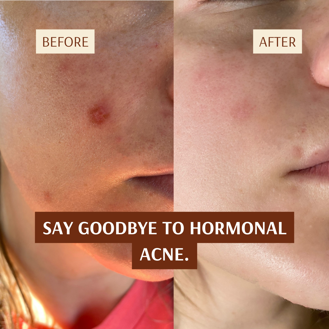 Hormonal Clear Concentrate