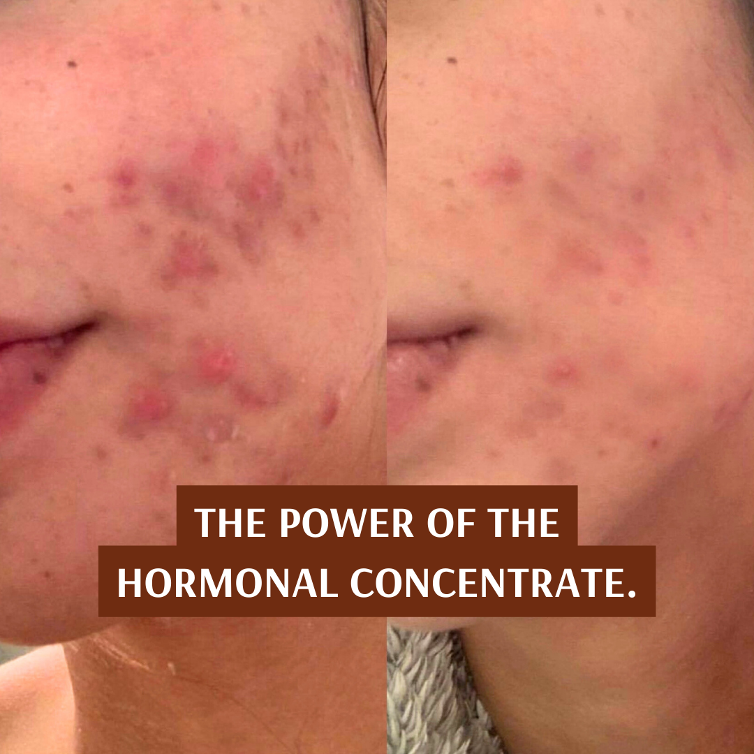 Hormonal Clear Concentrate